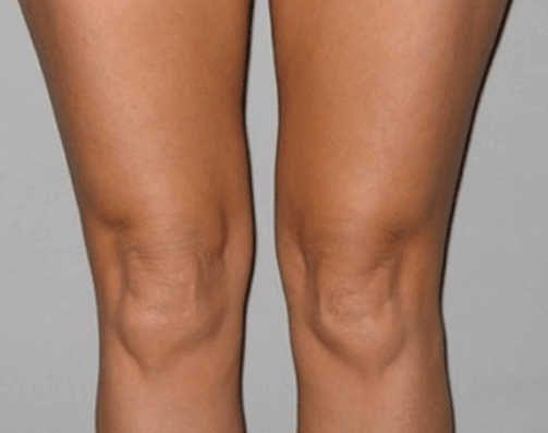 I cured knee arthrosis with Artovitel gel