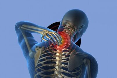 Neck pain with osteochondrosis