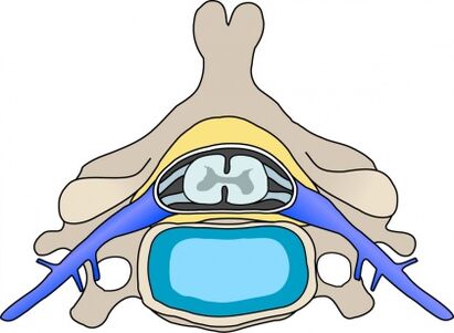 Protaby in the vertebrae with cervical osteochondrosis